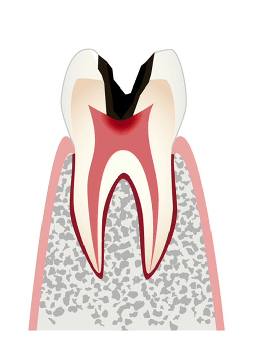歯髄（神経）に達した虫歯