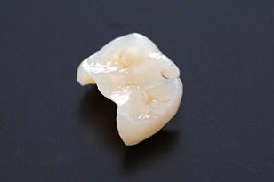 e.maxインレー